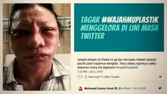 Setelah drama Ratna Sarumpaet terbongkar, operasi plastik menjadi pembicaraan warganet. Yuk kita mengenak operasi plastik lebih dekat.