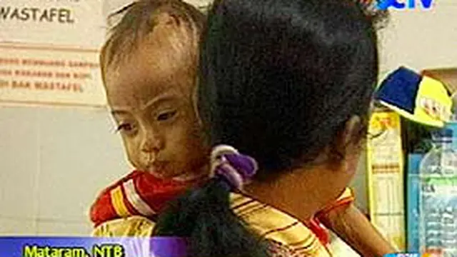 Penderita Busung Lapar di Mataram Sulit Disembuhkan - News Liputan6.com