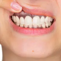 Inilah 3 Penyebab Gusi Hitam yang Anda Perlu Tahu (Stefano Garau/Shutterstock)