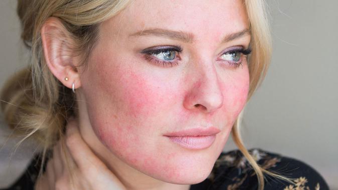 Ilustrasi penyakit kulit rosacea