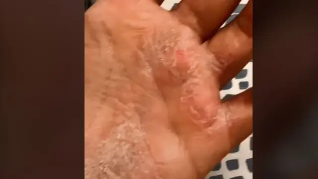 Perempuan berusia 17 tahun menderita psoriasis dan kondisinya makin parah usai pakai hand sanitizer