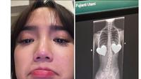 Fuji An Sedih Setelah Didiagnosis Skoliosis dan Mengetahui Tulang Belakang Miring. Skoliosis Adalah Kondisi Tulang Belakang Mengalami Kemiringan Sehingga Membentuk Huruf S atau C (instagram.com/fuji_an)