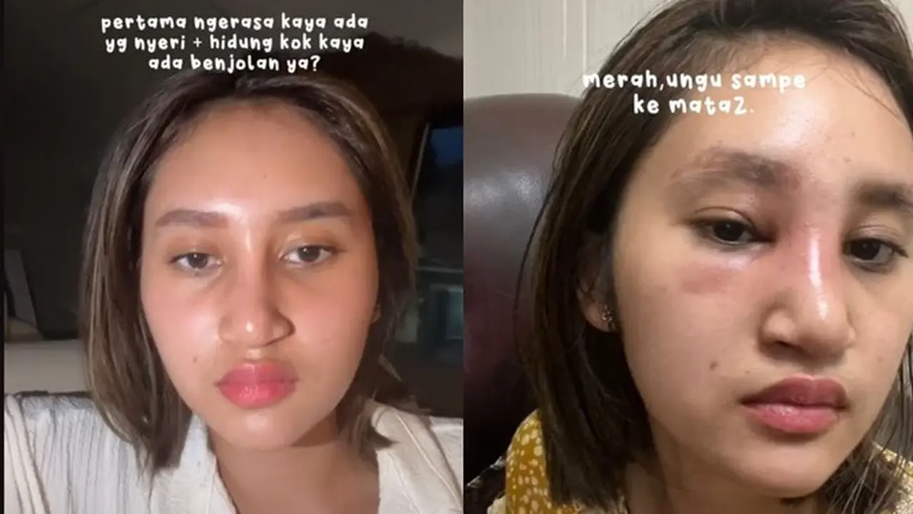 6 Potret Kronologi Dhyaz Anak Farida Nurhan Alami Infeksi Hidung Pasca Implan