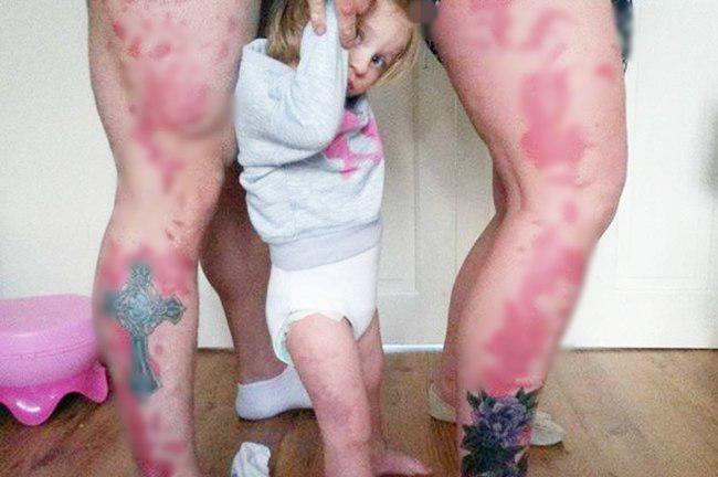 Tanya dan Adam mentato kaki mereka agar mirip dengan tanda lahir Honey | foto: copyright mirror.co.uk