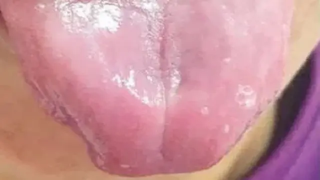 Lidah pria ini kehilangan papilanya karena kurang vitamin (Tangkapan Layar The Sun)