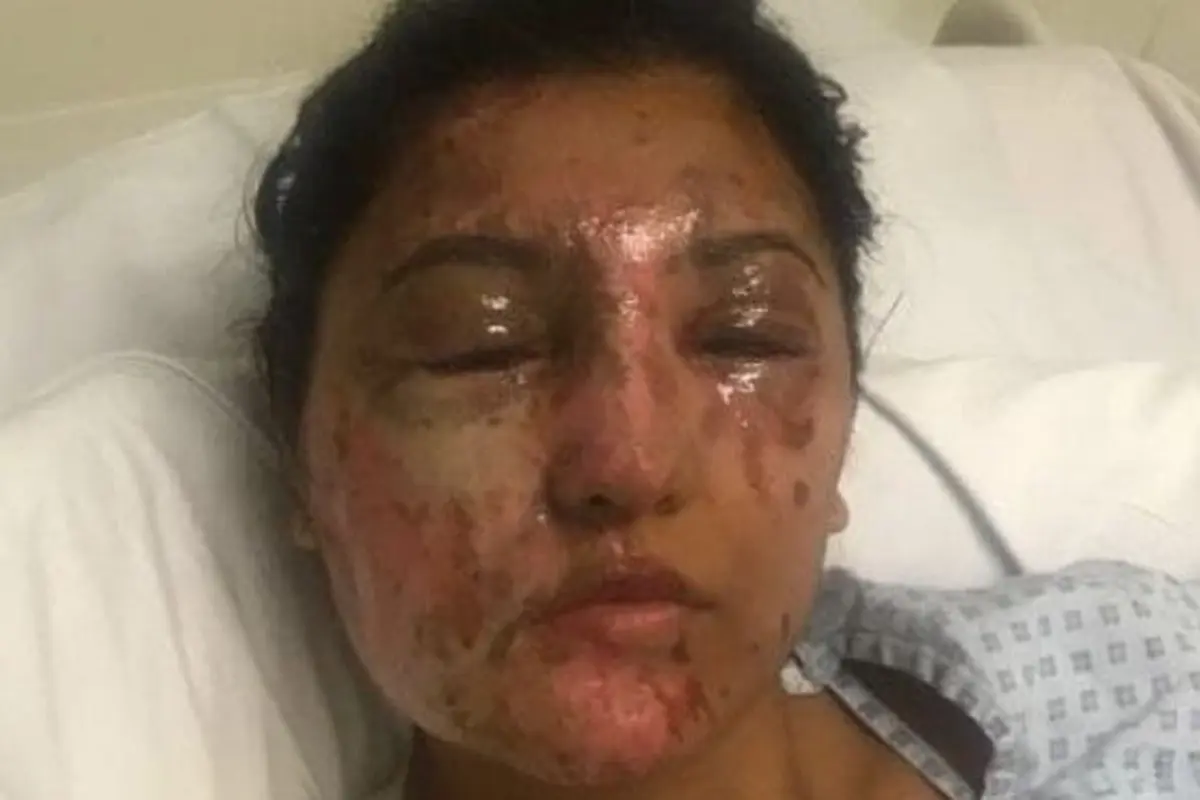 [Bintang] Setelah Disiram Air Keras, Penampilan Wanita Ini Buat Banyak Orang Shock