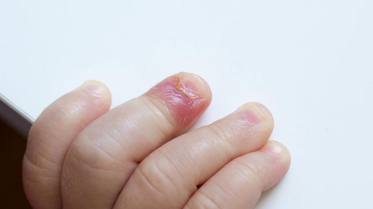 6 Cara Ampuh Cegah Kuku Cantengan