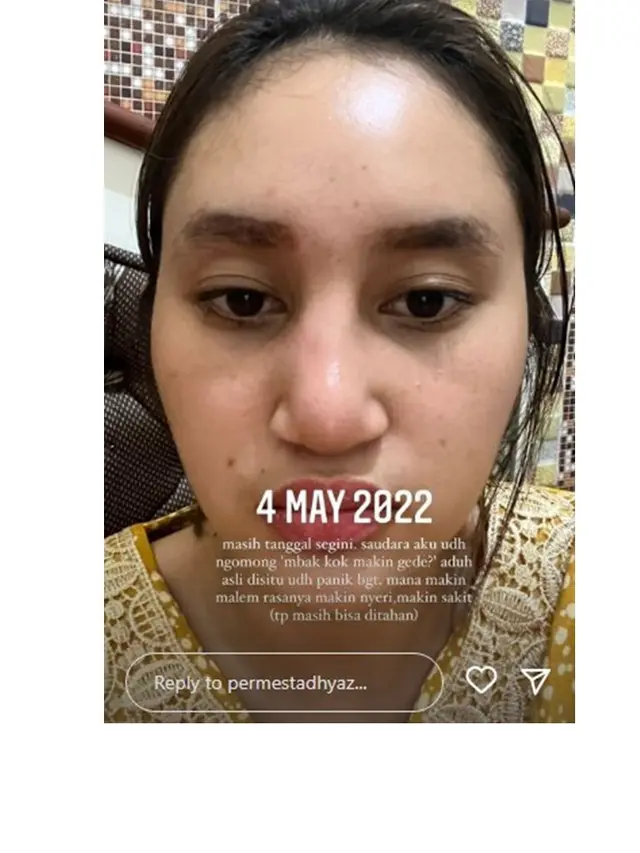 12 Foto Kronologi Dhyaz Anak Farida Nurhan Alami Infeksi Hidung hingga Angkat Implan