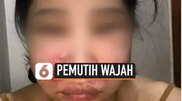 Seorang wanita rela melakukan perawatan kecantikan agar bisa mendapatkan warna kulit putih yang bersih. Namun, akibat ingin hasil yang instant, wajah wanita ini justru alami kerusakan.