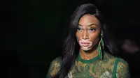 Model bernama Winnie Harlow menampilkan koleksi Spring/Summer 2018 untuk Elie Saab selama Paris Fashion Week, Minggu (1/10). Selain bersinar di dunia mode, Winnie juga aktif menjadi pembicara mewakili penderita vitiligo. (ALAIN JOCARD / AFP)