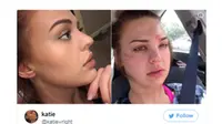 Asal Pencet Jerawat, Wajah Wanita Ini Jadi Babak Belur