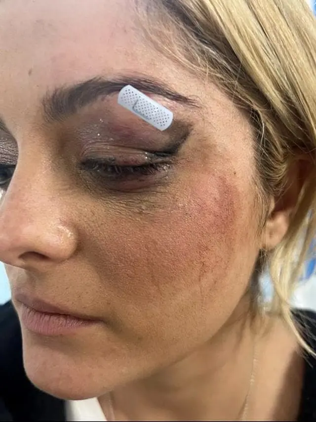 Potret Bebe Rexha yang mengalami luka akibat terlempar handphone penggemar.