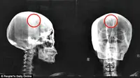Seorang wanita mengeluhkan pusing-pusing kepala dan ternyata ada paku bercokol di dalam kepalanya.