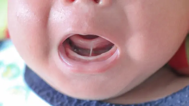 Tongue-tie (Ankyloglossia)