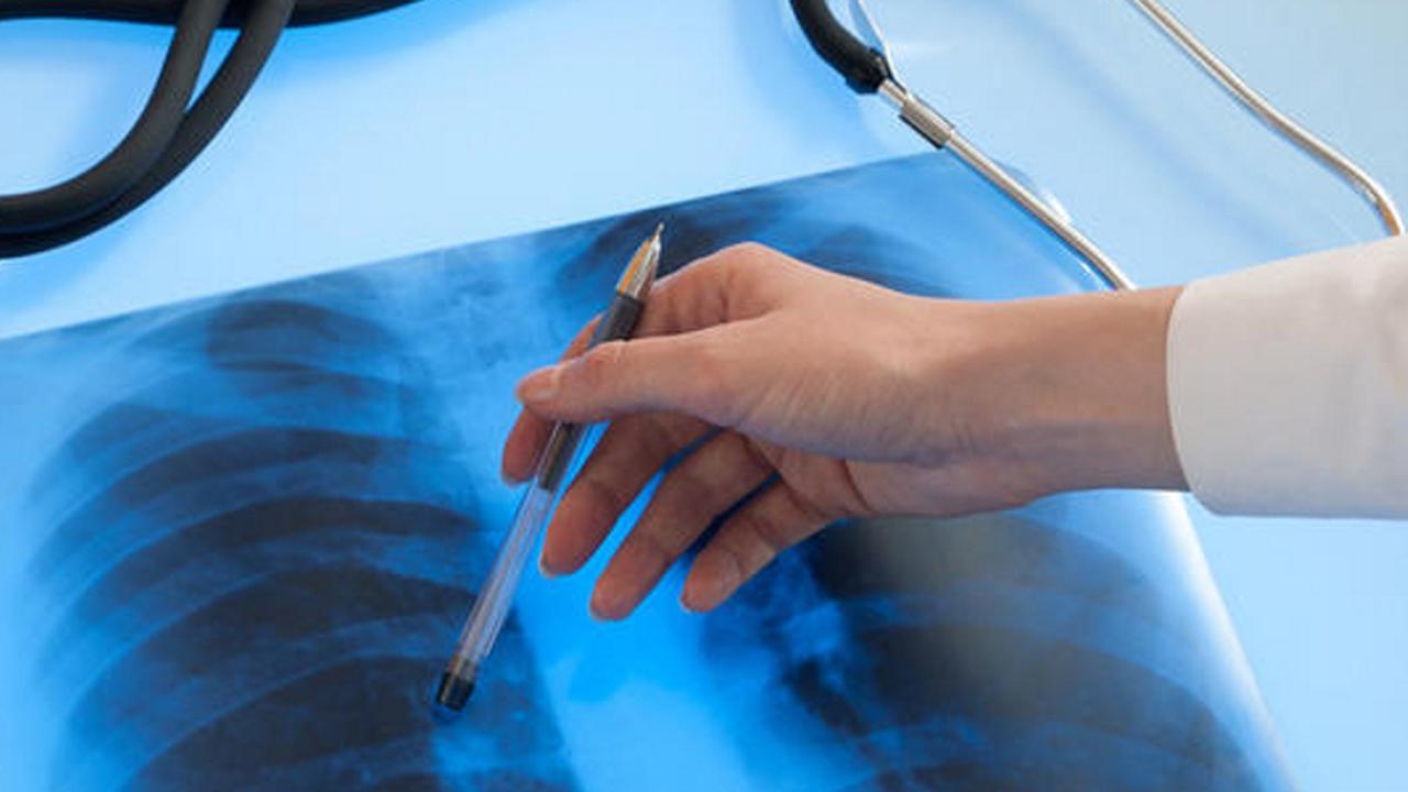 [Bintang] Ilustrasi kanker paru-paru yang bikin komedian Budi Anduk meninggal