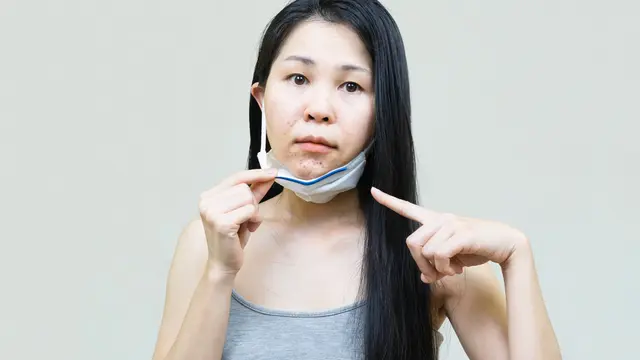 ilustrasi cara mengatasi maskne yang muncul pada saat pandemi/ANN PATCHANAN/shutterstock