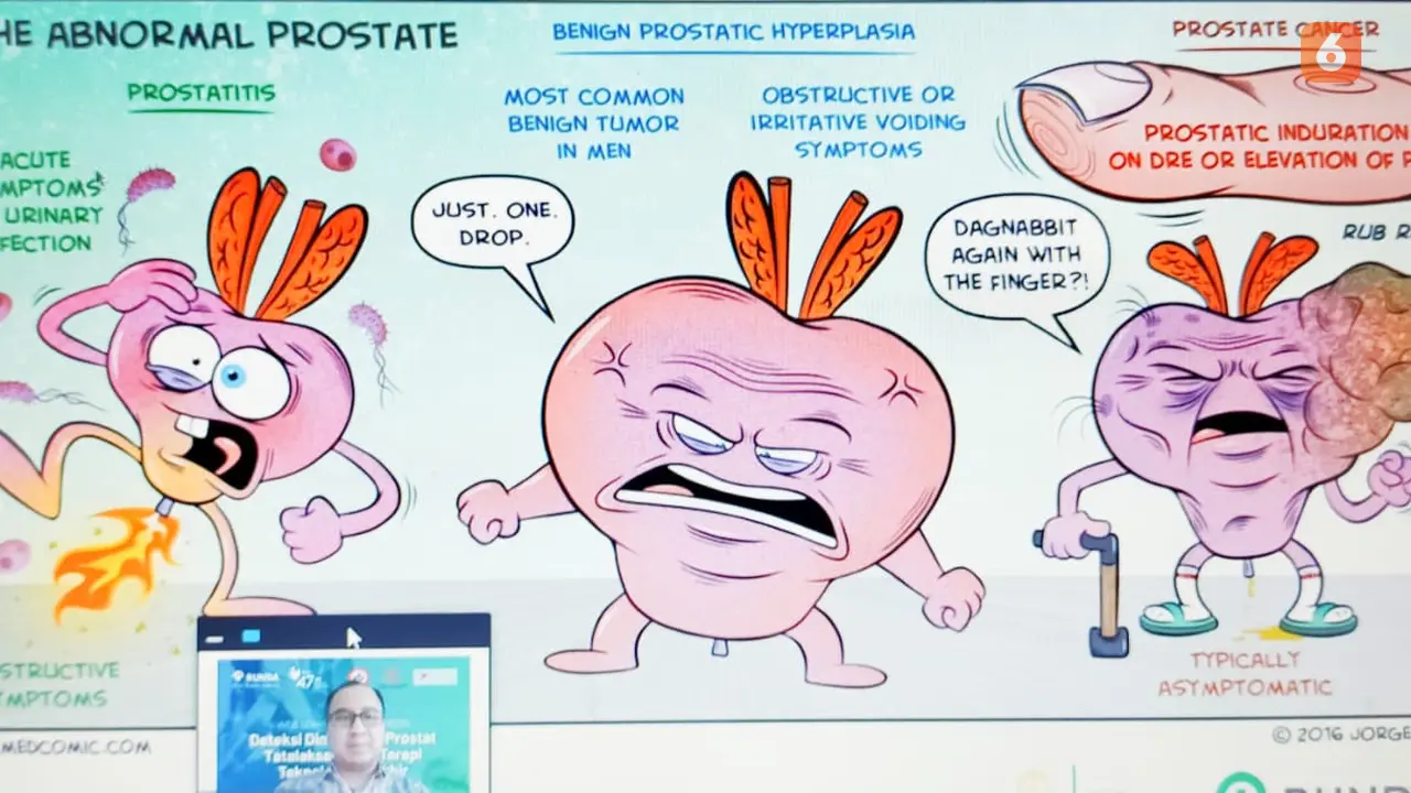 Kanker Prostat
