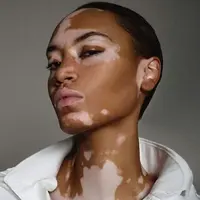 Akibat vitiligo, Amy Deanna memiliki warna kulit berbeda dari orang kebanyakan, tapi itu pulalah yang membuat ia sukses jadi seorang model. (Foto: Instagram/@amy.deanna)