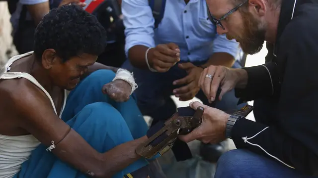 Tangan Palsu Buatan Mesin Cetak 3D Bantu Penderita Kusta di Kathmandu