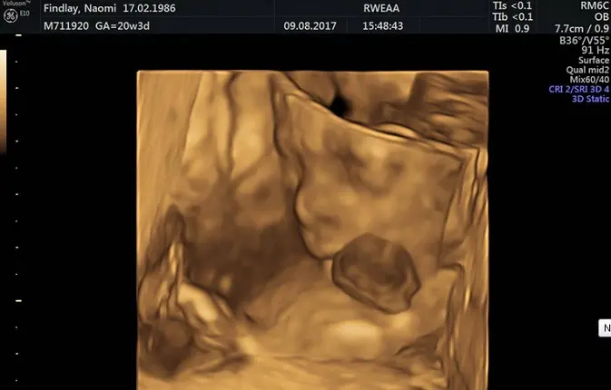 Jantung bayi Venellope terlihat di luar tubuh saat kandungan sang ibu memasuki usia 9 minggu. (University Hospitals of Leicester NHS Trust/PA Wire)
