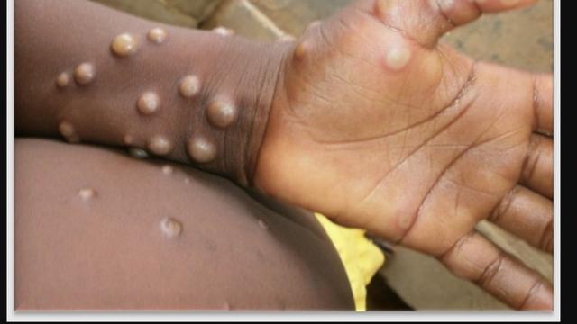 Monkeypox atau penyakit cacar monyet.