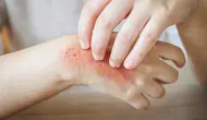 How to Relieve Itchy Skin After Contact with Caterpillar Hairs Without Expensive Medicine