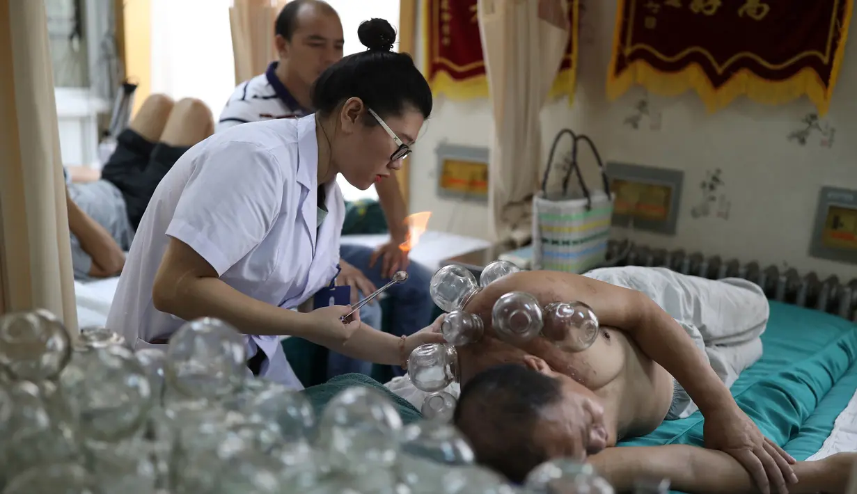 Seorang pasien menerima terapi beka api di sebuah rumah sakit di Shenyang di provinsi Liaoning, China timur laut (7/8). Terapi bekam api digunakan untuk menyegarkan sirkulasi darah. (AFP Photo/Str/China Out)