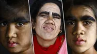 Keluarga Manusia `Serigala`di Nepal