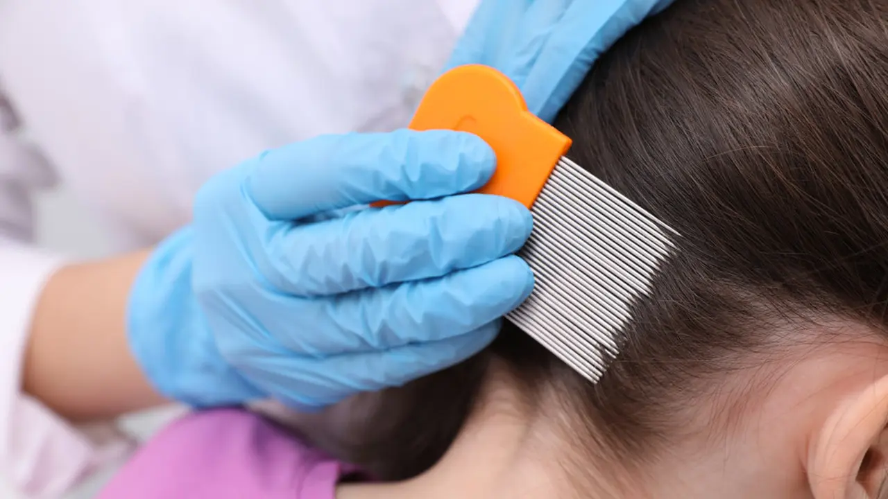 Kenapa Rambut yang Kutuan Menular Sedangkan Ketombean Tidak?