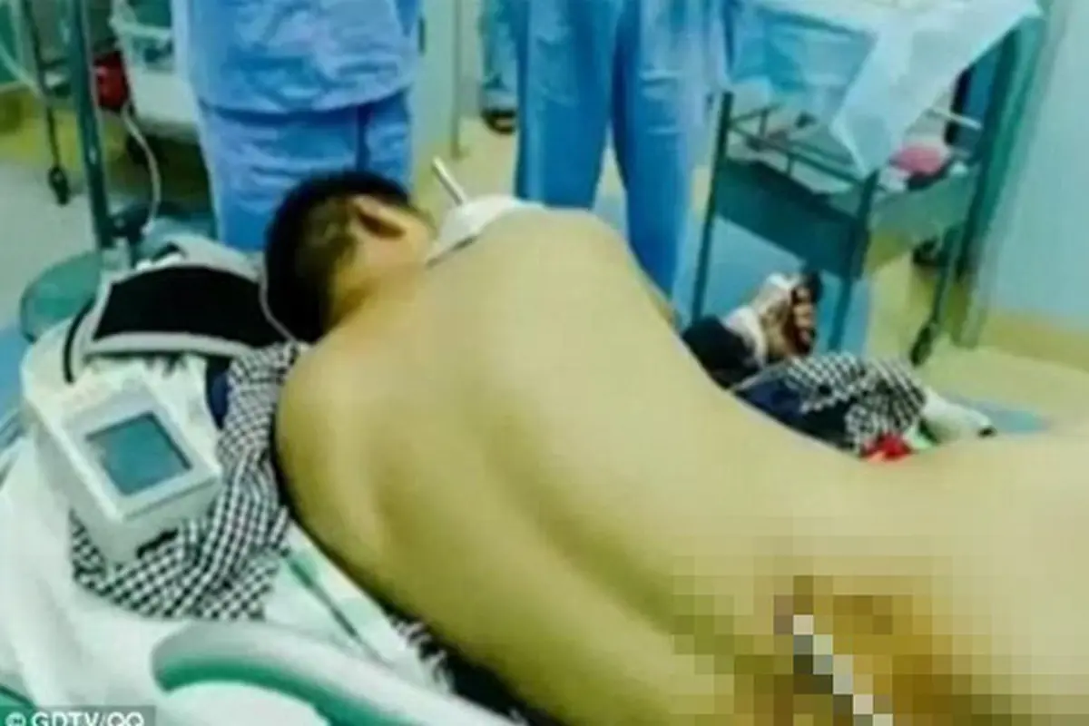 Kuli Bangunan Bertahan Hidup, Meski Besi 2 Meter Menembus Tubuh