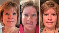 Judy Cloud unggah foto-foto sebelum dan setelah operasi pengangkatan kanker kulitnya di facebook untuk memberikan peringatan.