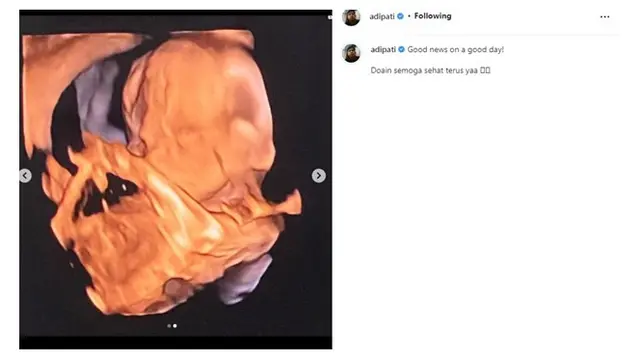 Umumkan Kehamilan, Ini 6 Potret Canti Tachril Istri Adipati Dolken Pamer Baby Bump