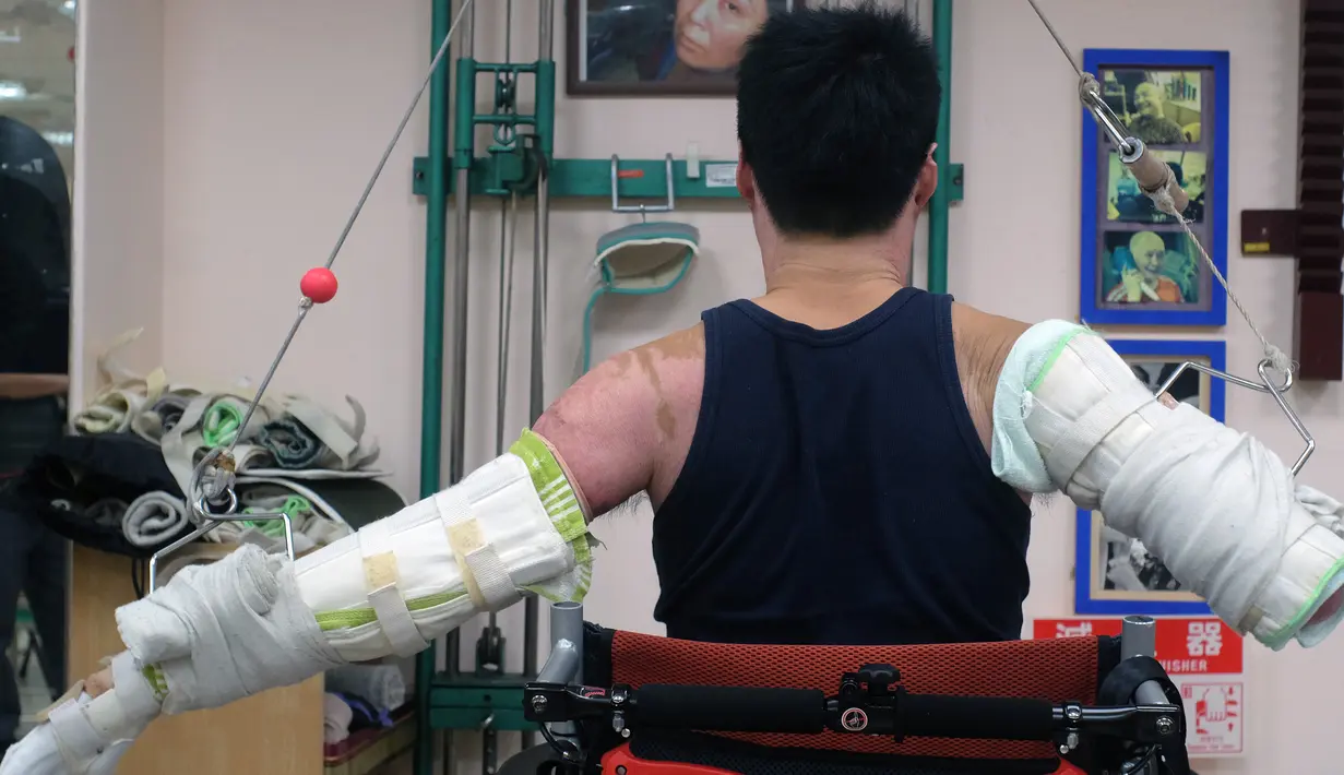 Huang Po - wei saat melakukan sesi rehabilitasi di pusat pemulihan di Taipe, Taiwan, (26/1/2016).Meski dengan 90 persen badannya terkena luka bakar tidak menyurutkannya untu tetap menjalani hidup dan pendidikan sarjananya. (SAM YEH / AFP)