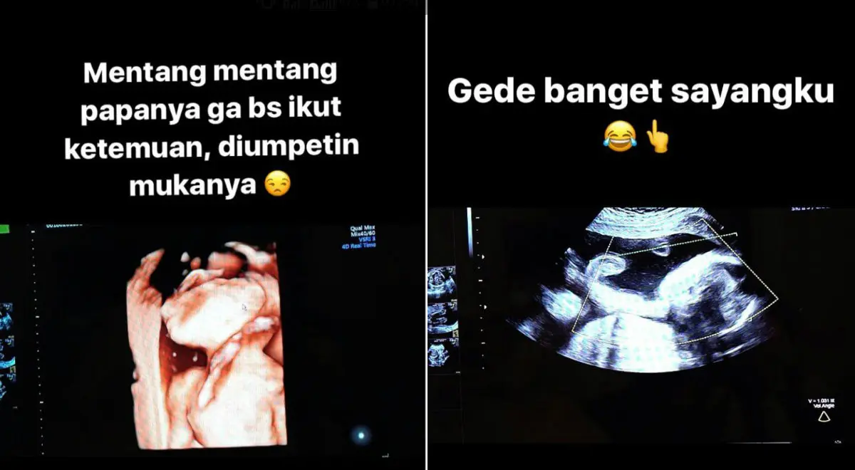 Hasil USG anak Sandra Dewi dan Harvey Moeis. (Instagram/sandradewi88)