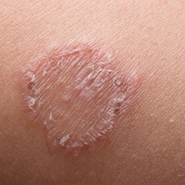 12 Cara Menghilangkan Kurap Dengan Bahan Alami Cegah Penularan Hot Liputan6 Com
