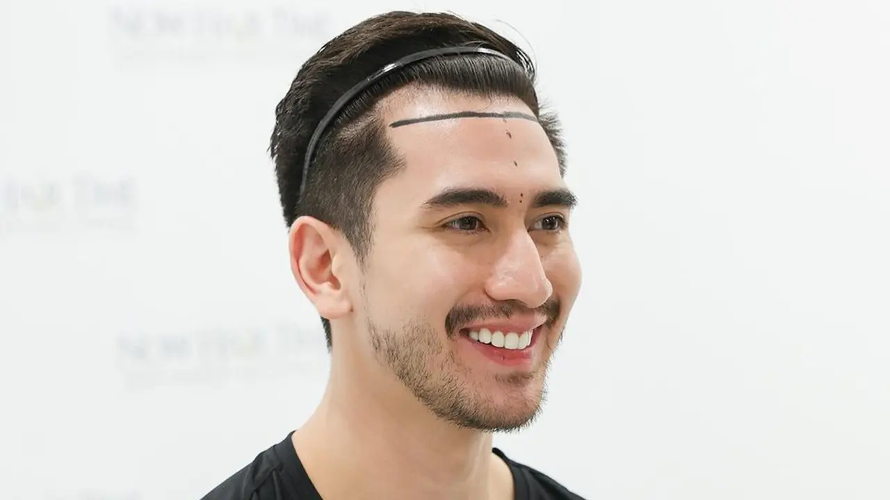 Verrell Bramasta Tampil Botak Usai Transplantasi Rambut, Curi Perhatian