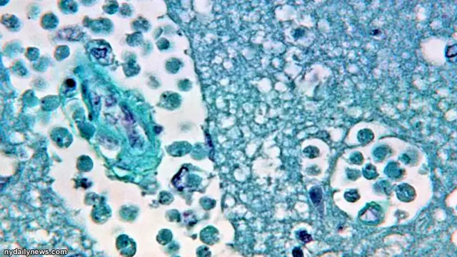 infeksi-amoeba-130828b.jpg
