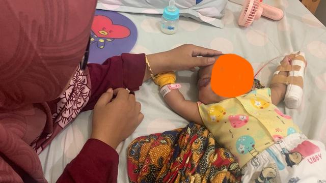 Hemangomia di dekat mata bayi. (Foto: Liputan6.com/Dok. RSI Banjarnegara)