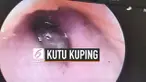 Seorang wanita mengeluh ada sesuatu di dalam kupingnya. Setelah diperiksa ternyata ditemukan kutu penghisap darah yang ada di saluran telinga.
