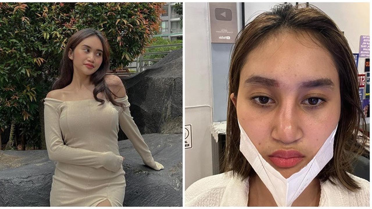 Sempat Oplas, Ini 6 Potret Permesta Dhyaz Anak Farida Nurhan Alami Infeksi Implan