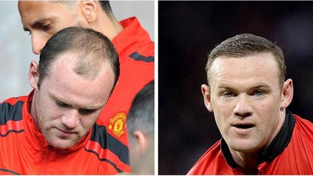 6 Artis yang Pernah Transplantasi Rambut, Terbaru Atta Halilintar