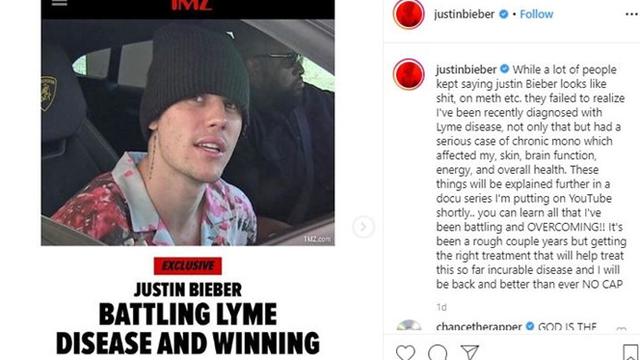 6 Artis yang Pernah Idap Penyakit Lyme Disease, Terbaru Justin Bieber