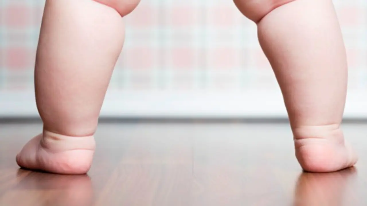 Lemak Pada Anak Obesitas dapat Ganggu Pertumbuhan Tulangnya
