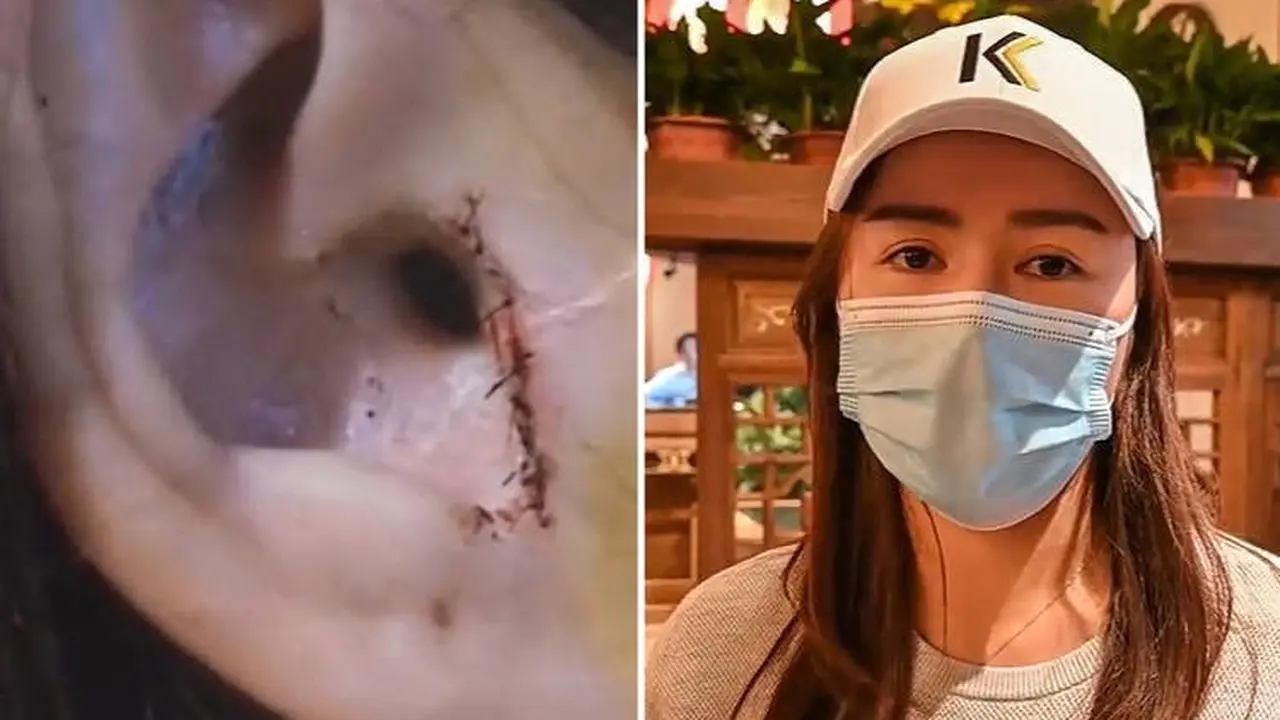 wanita kehilangan tulang rawan telinganya usai operasi hidung