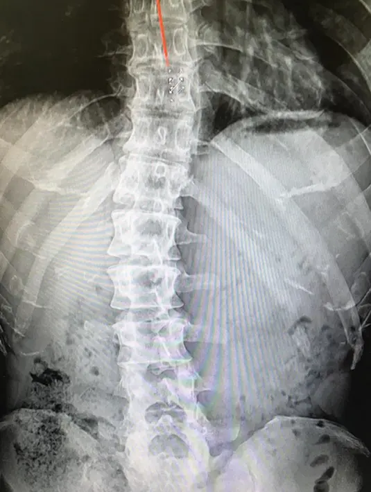 Melansir Allkpop (4/11), Jong Kook mengunggah foto hasil rontgen pada bagian belakangnya. Ia menuturkan alasan dirinya menjalani tugas tersebut. (Instagram/kjk76)