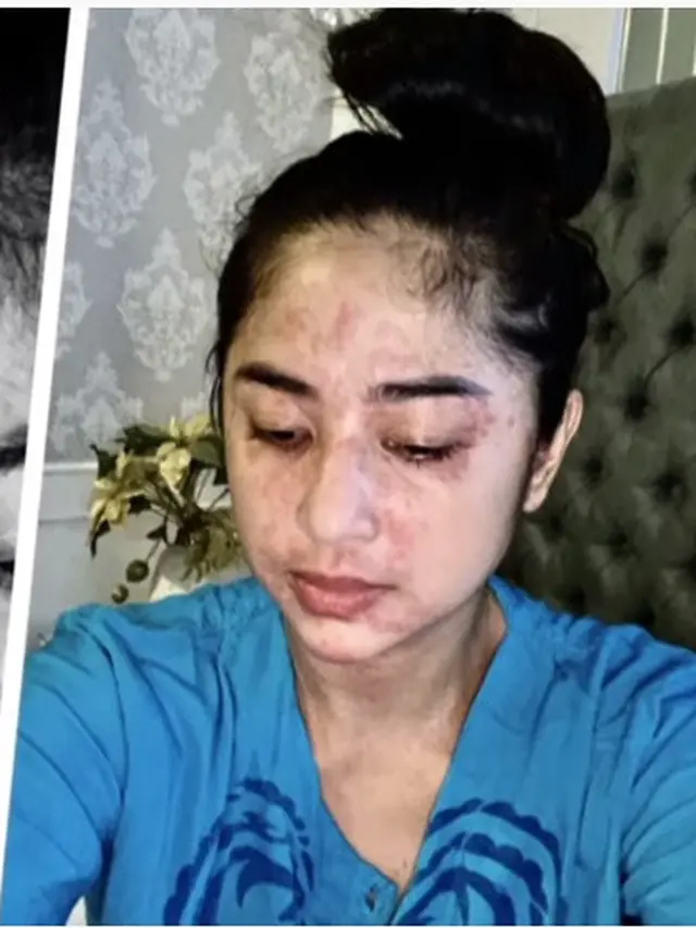 7 Potret Dewi Perssik saat Alami Gejala Corona Covid-19, Penuh Ruam Merah