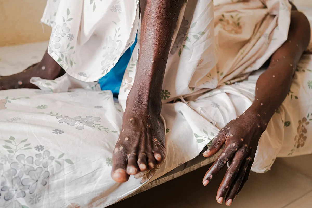 Burundi Mencatat 171 Kasus Mpox