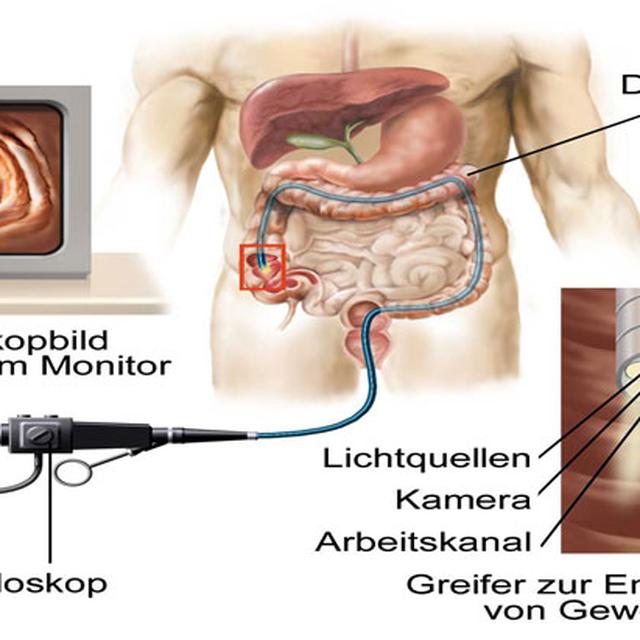 Tiga Pilihan Skrining Untuk Deteksi Kanker Usus Besar Health Liputan6 Com