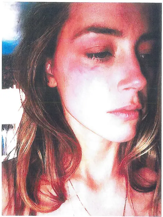Amber Heard menunjukkan luka diwajahnya akibat perlakukan suaminya Johnny Depp. Amber mengutarakan kepada hakim, bahwa Johnny Deep telah memukulkan telepon genggam pada wajahnya disaat Amber menelepon temannya. (Superior Court of Los Angeles/Reuters)