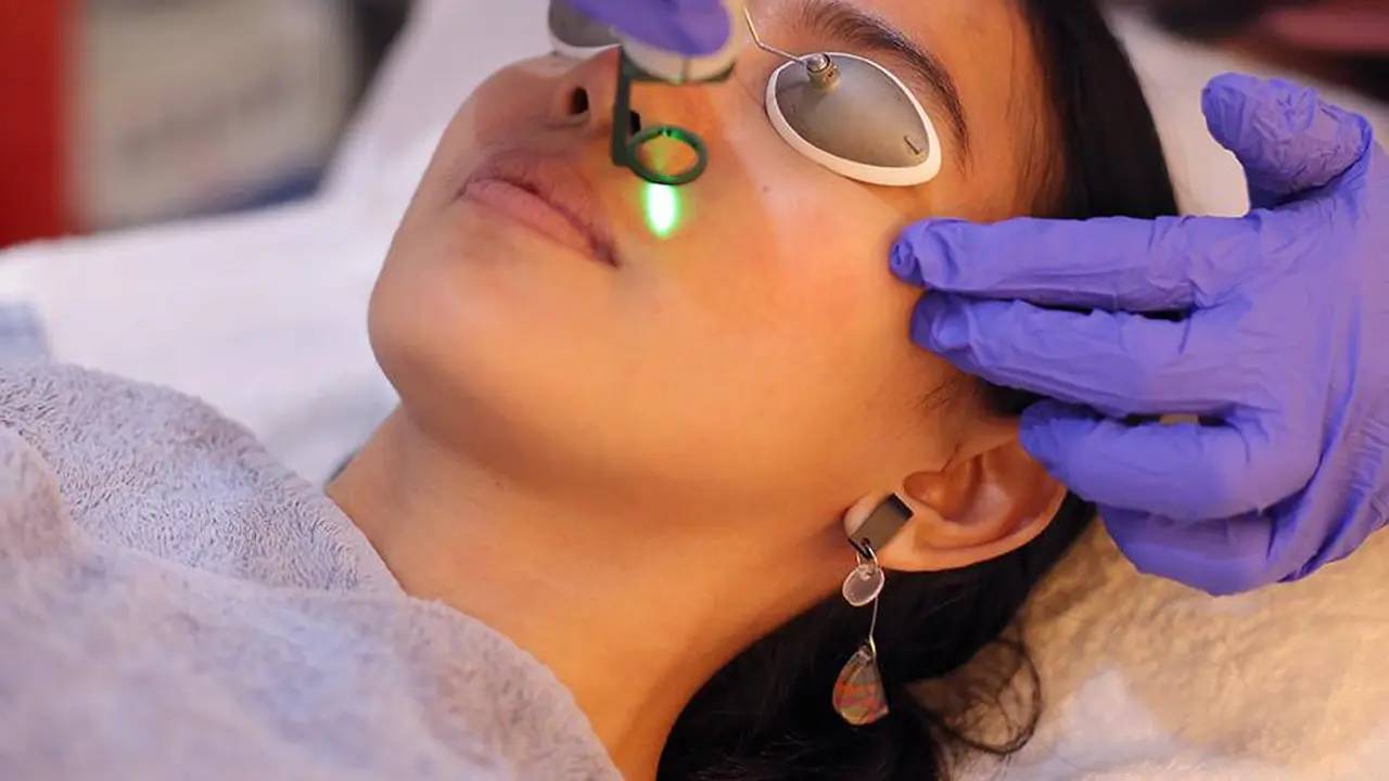 Beauty Info: Laser Wajah untuk Hilangkah Jerawat